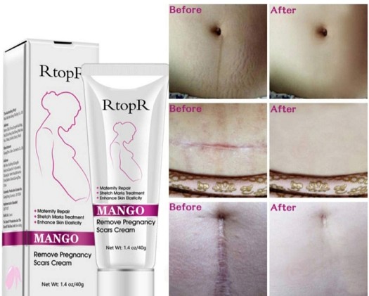 Mango remove pregnancy scars cream