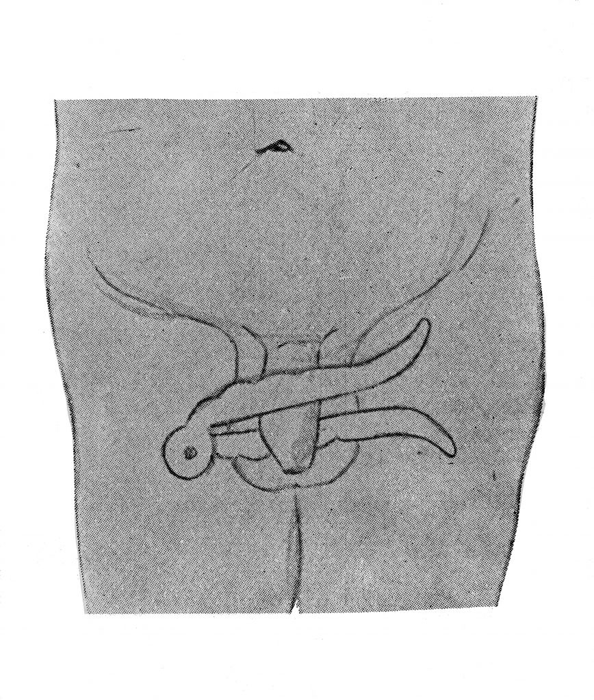 circoncision